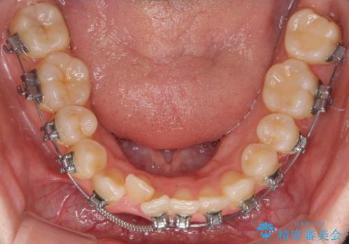 八重歯が気になる。補助装置を併用したワイヤー矯正の治療中