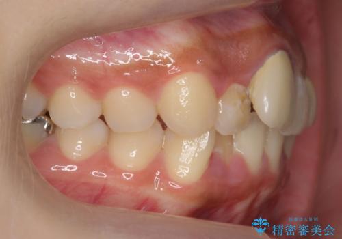 前歯のがたつき 保険治療の前歯の被せ物もやりかえたいの治療前