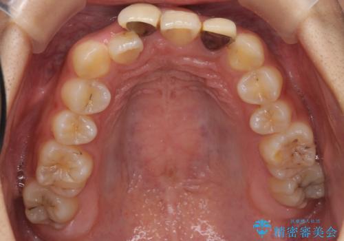 前歯のがたつき 保険治療の前歯の被せ物もやりかえたいの治療前