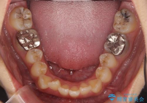 前歯のがたつき 保険治療の前歯の被せ物もやりかえたいの治療前