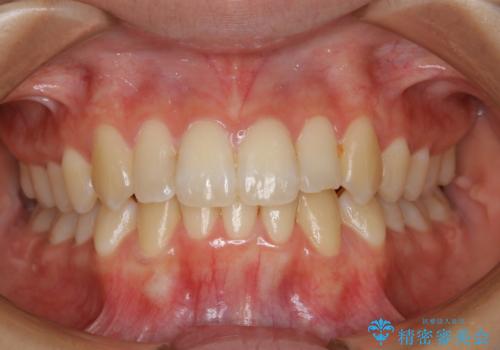 下顎前歯の先天欠損と上顎前歯のクロスバイト:インビザライン治療の治療後