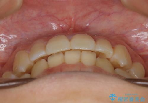 下顎前歯の先天欠損と上顎前歯のクロスバイト:インビザライン治療の治療後