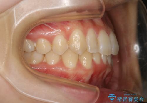 下顎前歯の先天欠損と上顎前歯のクロスバイト:インビザライン治療の治療後