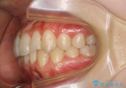 下顎前歯の先天欠損と上顎前歯のクロスバイト:インビザライン治療の治療後
