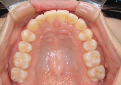 下顎前歯の先天欠損と上顎前歯のクロスバイト:インビザライン治療の治療後
