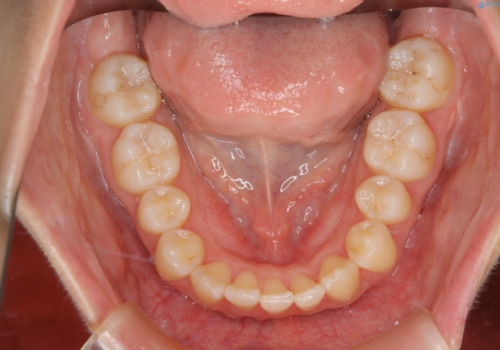 下顎前歯の先天欠損と上顎前歯のクロスバイト:インビザライン治療の治療後