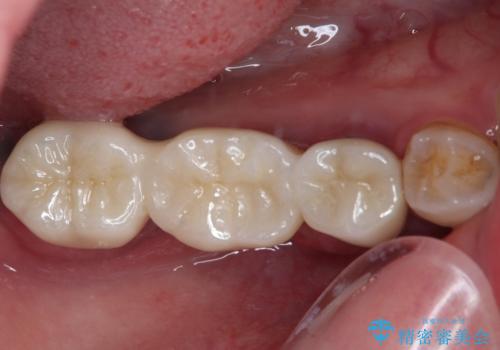 奥歯がぐらぐらする インプラントによる補綴治療の症例 治療前