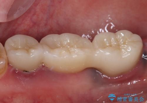 奥歯がぐらぐらする インプラントによる補綴治療の治療前