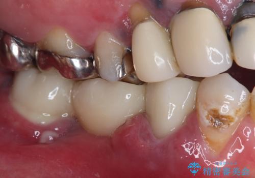 奥歯がぐらぐらする インプラントによる補綴治療の治療前