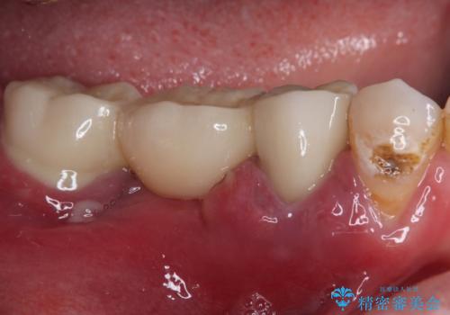 奥歯がぐらぐらする インプラントによる補綴治療の治療前