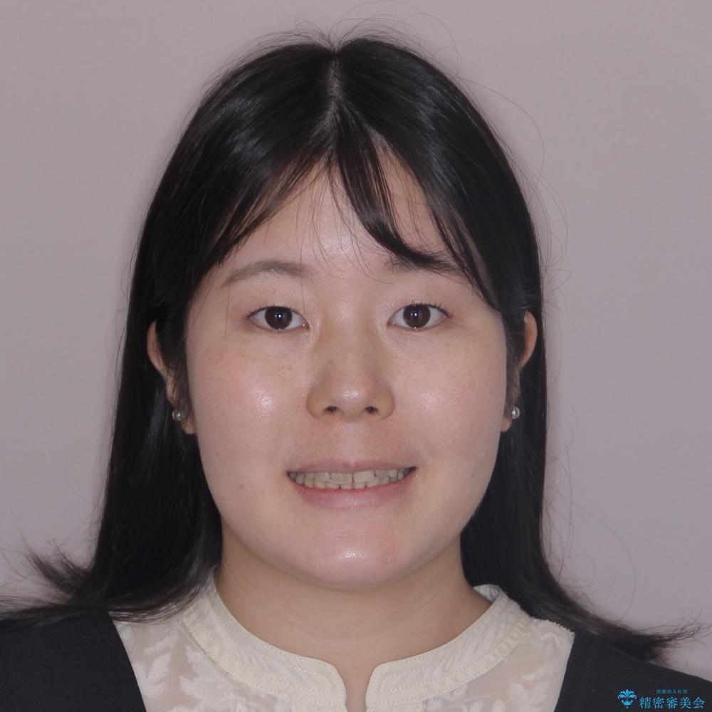 【モニター】デコボコ前歯を治したい ワイヤー装置での抜歯矯正治療の治療後(顔貌)