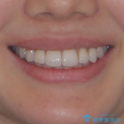 上下前歯のデコボコ ワイヤー装置で楽ちん矯正治療の治療後(顔貌)