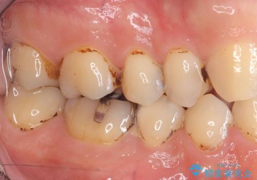 虫歯治療|歯を長持ちさせるための治療|セラミッククラウン|審美回復|精密根管治療の治療前