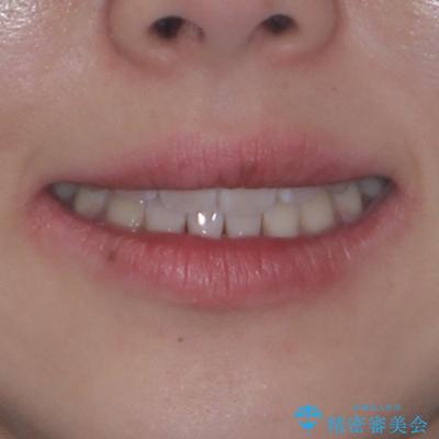 上下非接触の前歯 口元の突出感を改善する抜歯矯正の治療後(顔貌)