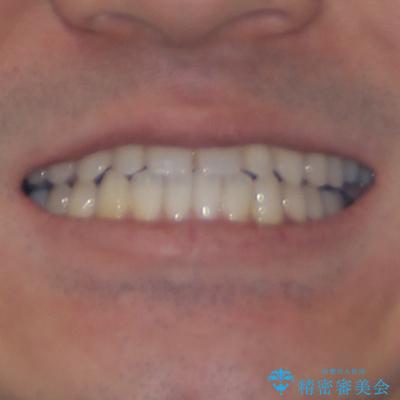 内側に引っ込んだ歯を治したい インビザラインの矯正治療の治療後(顔貌)