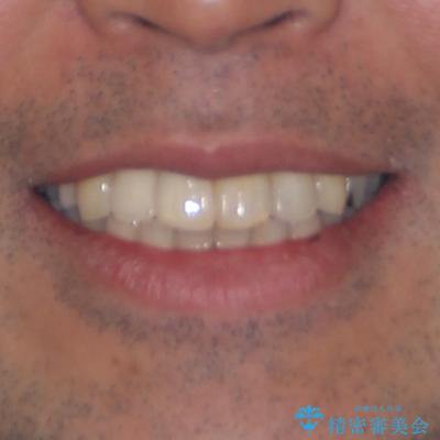 隠れている前歯 インビザライン矯正治療と前歯のセラミック治療の治療後(顔貌)