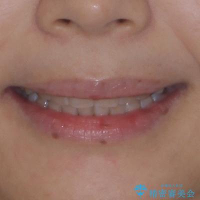 ディープバイトと前歯のデコボコ インビザラインによる矯正治療の治療後(顔貌)
