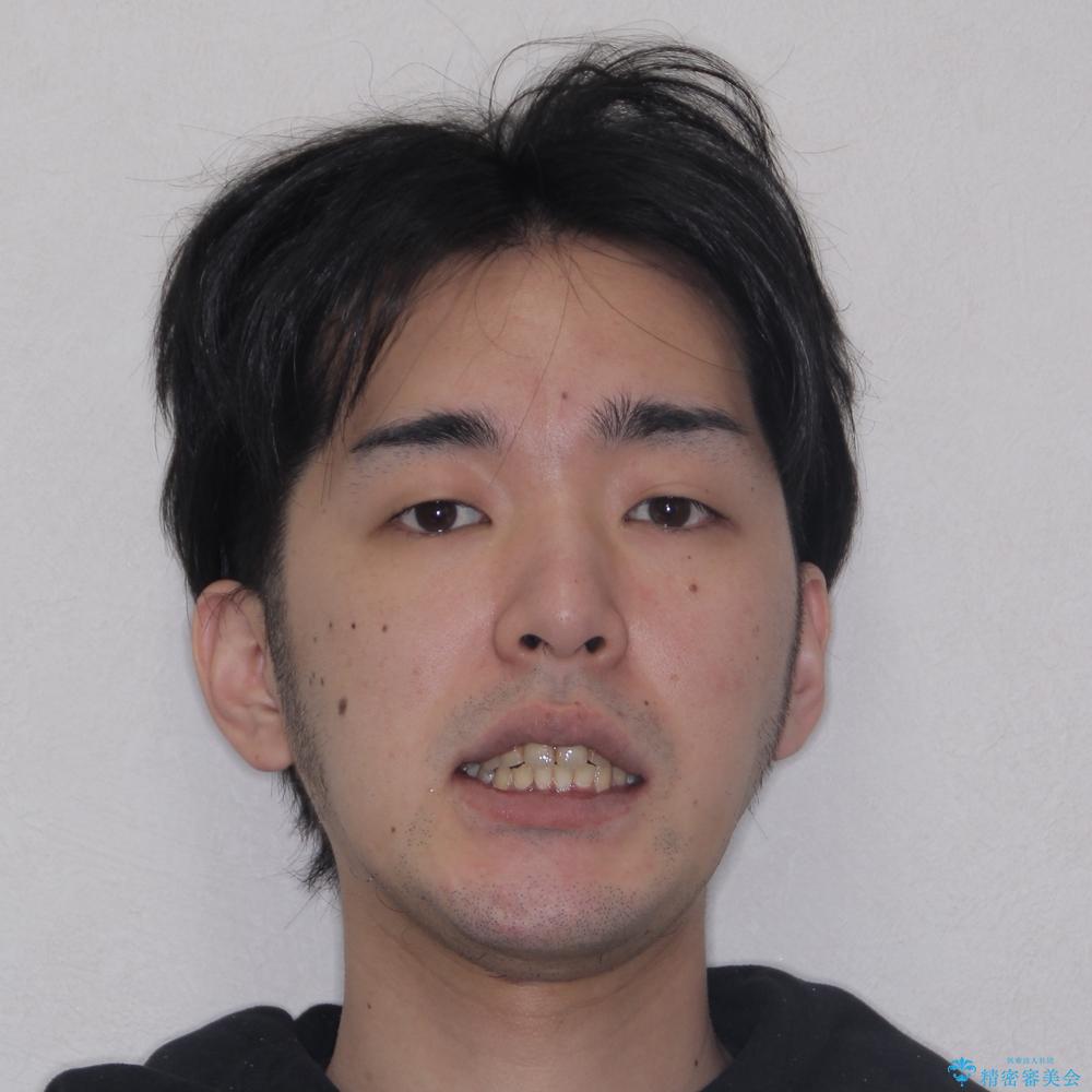 【モニター】飛び出した上の前歯 非抜歯矯正で整った口元にの治療後(顔貌)