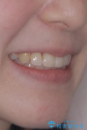 八重歯が気になる。補助装置を併用したワイヤー矯正の治療後(顔貌)