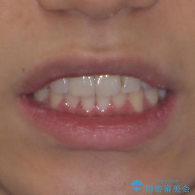 前方に捻れた前歯を治したい インビザライン矯正治療の治療後(顔貌)