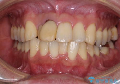 隠れている前歯 インビザライン矯正治療と前歯のセラミック治療の症例 治療前