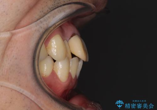 隠れている前歯 インビザライン矯正治療と前歯のセラミック治療の治療前