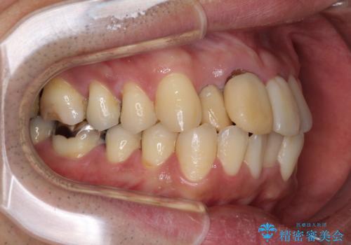 隠れている前歯 インビザライン矯正治療と前歯のセラミック治療の治療前