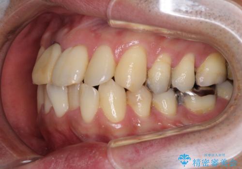 隠れている前歯 インビザライン矯正治療と前歯のセラミック治療の治療前