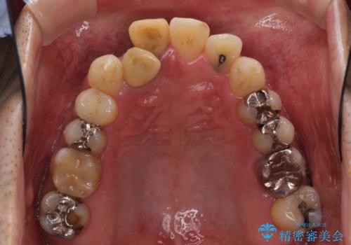 隠れている前歯 インビザライン矯正治療と前歯のセラミック治療の治療前