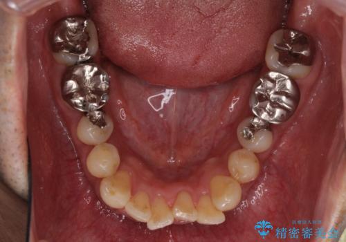 隠れている前歯 インビザライン矯正治療と前歯のセラミック治療の治療前