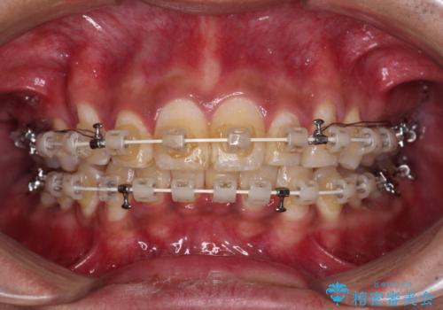 深い咬み合わせと前歯のデコボコ ワイヤー装置での抜歯矯正の治療中