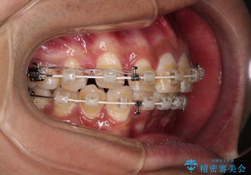 深い咬み合わせと前歯のデコボコ ワイヤー装置での抜歯矯正の治療中