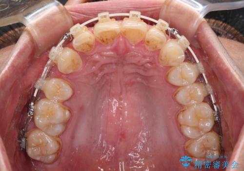 深い咬み合わせと前歯のデコボコ ワイヤー装置での抜歯矯正の治療中