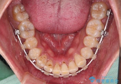 深い咬み合わせと前歯のデコボコ ワイヤー装置での抜歯矯正の治療中