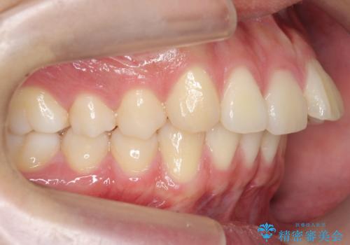 出っ歯の治療 インビザラインで抜歯矯正 親知らずを使用した矯正の治療前
