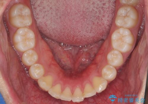 出っ歯の治療 インビザラインで抜歯矯正 親知らずを使用した矯正の治療前