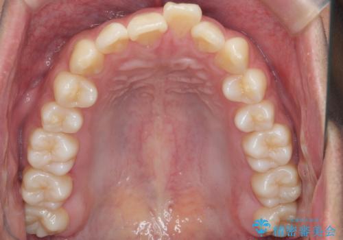 出っ歯の治療 インビザラインで抜歯矯正 親知らずを使用した矯正の治療前