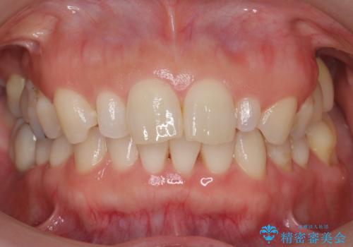 前歯が大きいのが気になる セラミックで整えたいの治療前