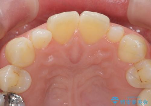 前歯が大きいのが気になる セラミックで整えたいの治療前
