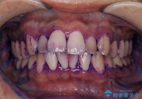 セラミックを付ける前にエアフローで綺麗ににクリーニングの症例 治療前