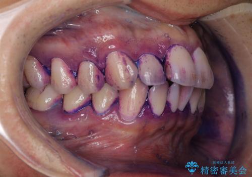 セラミックを付ける前にエアフローで綺麗ににクリーニングの治療前