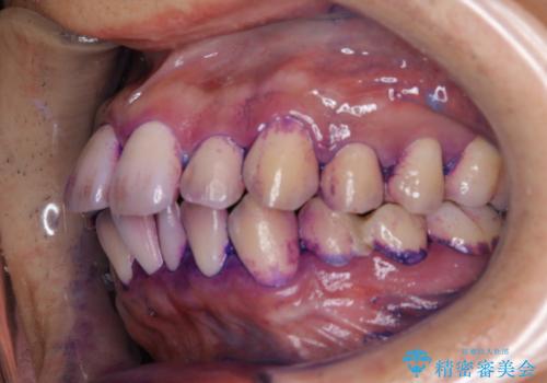 セラミックを付ける前にエアフローで綺麗ににクリーニングの治療前