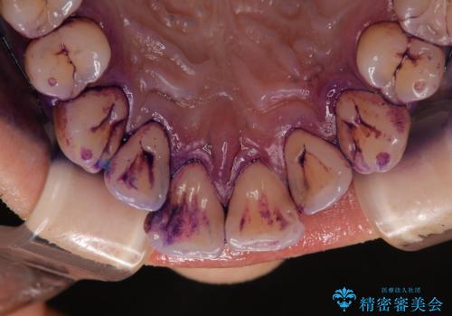セラミックを付ける前にエアフローで綺麗ににクリーニングの治療前