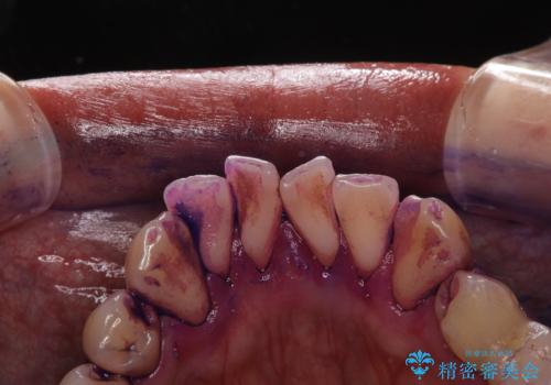 セラミックを付ける前にエアフローで綺麗ににクリーニングの治療前