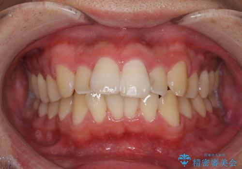 セラミックを付ける前にエアフローで綺麗ににクリーニングの症例 治療後