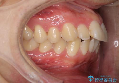 セラミックを付ける前にエアフローで綺麗ににクリーニングの治療後