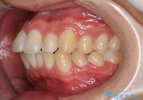 セラミックを付ける前にエアフローで綺麗ににクリーニングの治療後