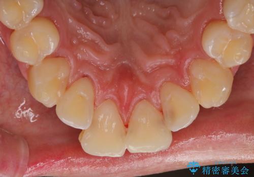 セラミックを付ける前にエアフローで綺麗ににクリーニングの治療後