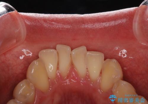 セラミックを付ける前にエアフローで綺麗ににクリーニングの治療後