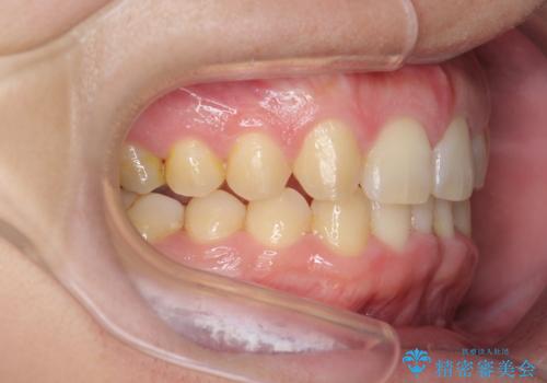 前歯のすき間 歯のがたつきの治療後